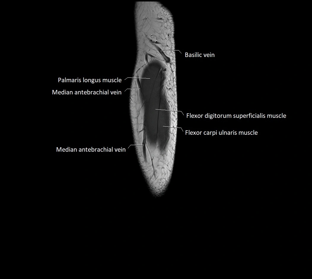 MRI 3T forearm sagittal labelled cross sectional anatomy image 38.webp